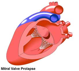 Mitral Valve Prolapse